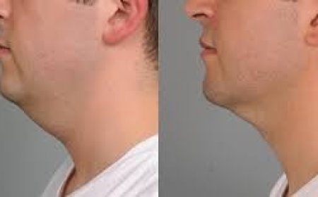 Sculpting Confidence: The Ultimate Guide to Neck Liposuction NYC