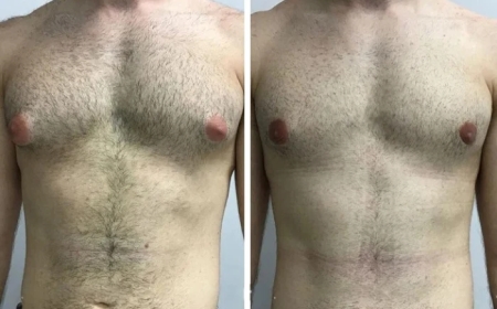 Top Clinics Offering Access to the Best Gynecomastia Surgeons in Dubai