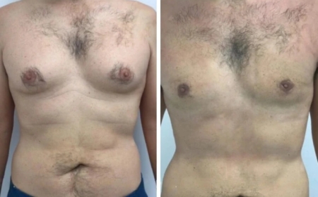 How to Achieve a Balanced Look with the Best Gynecomastia Surgeons in dubai