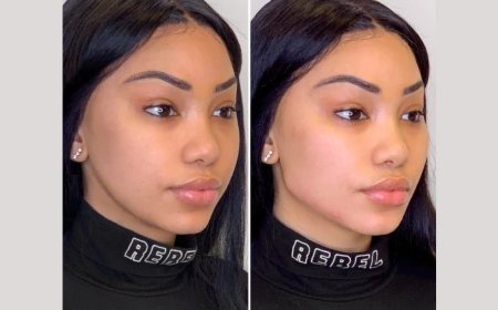 How the Best Doctors in Dubai Perform Thread Lifts to Address Sagging Skin and Wrinkles