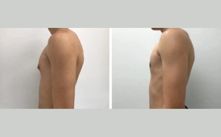 Gynecomastia Surgery Cost in Dubai: What the Best Doctors Charge