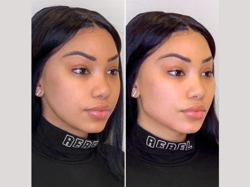 How the Best Doctors in Dubai Perform Thread Lifts to Address Sagging Skin and Wrinkles