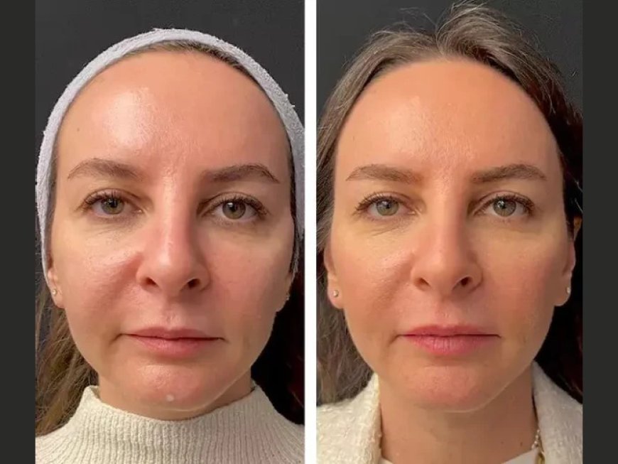 Is Mesotherapy Right for You? Insights from the Best Aesthetic Clinic in Dubai