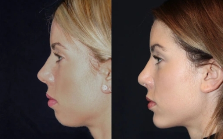 Best Aesthetic Clinic in dubai for Chin Fillers: What to Expect During Treatment