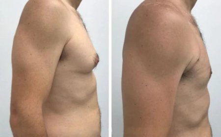 Understanding Gynecomastia: Causes, Symptoms, and Treatment in Dubai