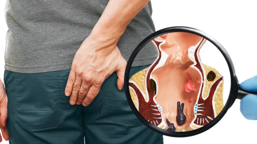 Hemorrhoid Treatment That Works: Natural and Medical Relief Options