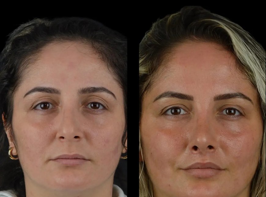 Before and After: Real Results from Cheek Fillers Treatment in Dubai
